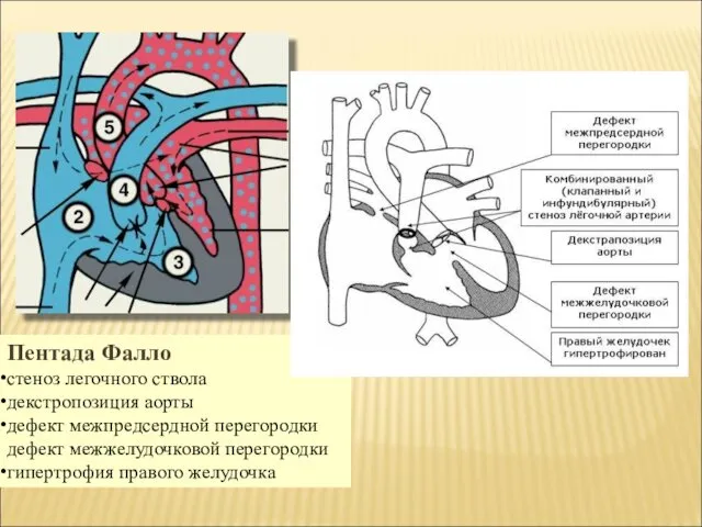 Пентада Фалло стеноз легочного ствола декстропозиция аорты дефект межпредсердной перегородки дефект межжелудочковой перегородки гипертрофия правого желудочка