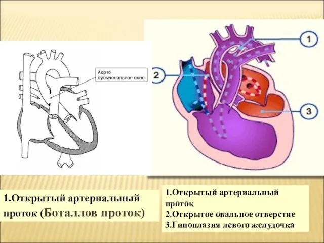 1.Открытый артериальный проток 2.Открытое овальное отверстие 3.Гипоплазия левого желудочка 1.Открытый артериальный проток (Боталлов проток)