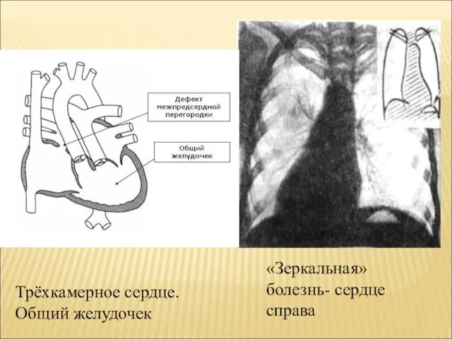 Трёхкамерное сердце. Общий желудочек «Зеркальная» болезнь- сердце справа