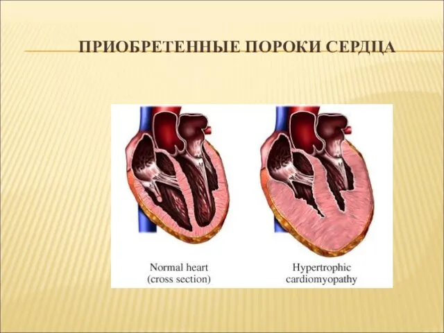 ПРИОБРЕТЕННЫЕ ПОРОКИ СЕРДЦА