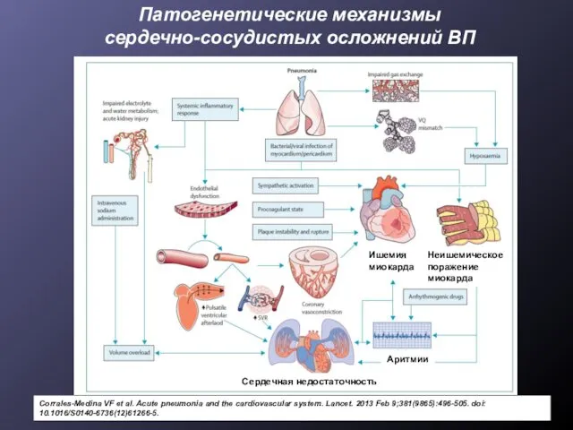 Патогенетические механизмы сердечно-сосудистых осложнений ВП Corrales-Medina VF et al. Acute pneumonia