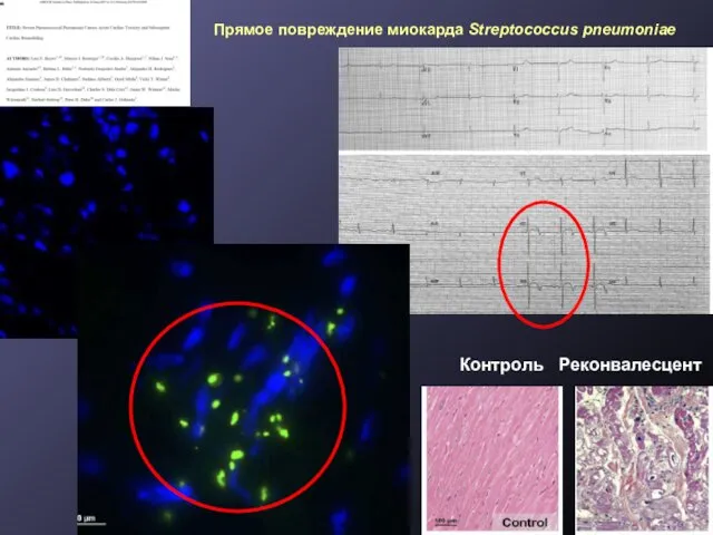 Прямое повреждение миокарда Streptococcus pneumoniae Контроль Реконвалесцент