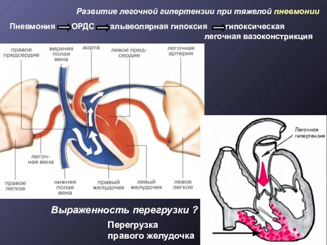 Пневмония ОРДС альвеолярная гипоксия гипоксическая легочная вазоконстрикция Развитие легочной гипертензии при