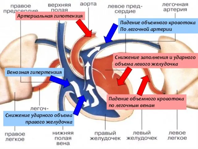 Снижение ударного объема правого желудочка Падение объемного кровотока По легочной артерии