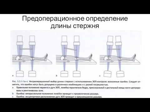 Предоперационное определение длины стержня