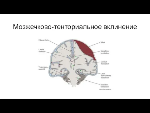 Мозжечково-тенториальное вклинение