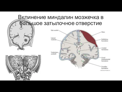 Вклинение миндалин мозжечка в большое затылочное отверстие