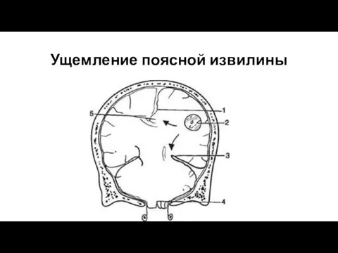 Ущемление поясной извилины