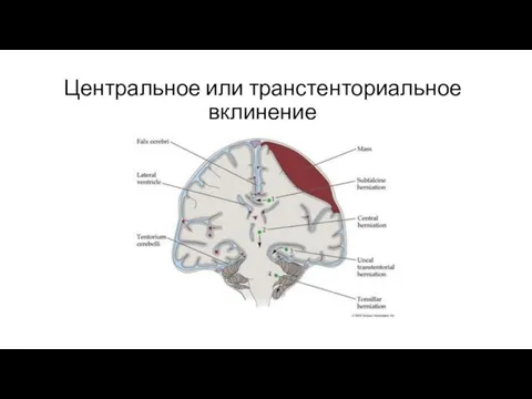 Центральное или транстенториальное вклинение