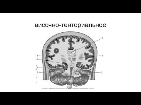 височно-тенториальное