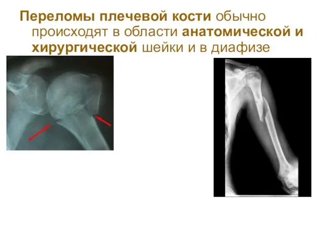 Переломы плeчeвой кости обычно происходят в области анатомической и хирургической шейки и в диафизе