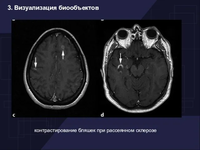 3. Визуализация биообъектов контрастирование бляшек при рассеянном склерозе