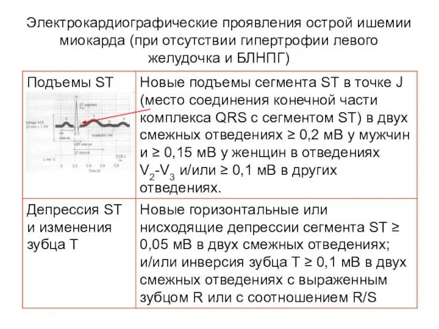 Электрокардиографические проявления острой ишемии миокарда (при отсутствии гипертрофии левого желудочка и БЛНПГ)