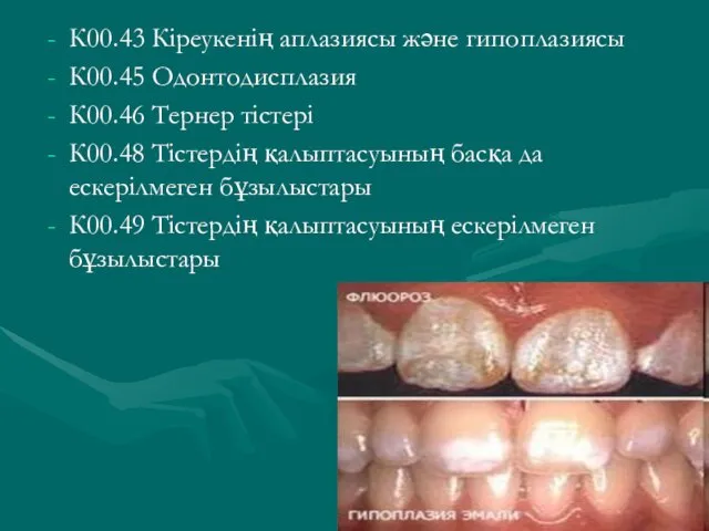 К00.43 Кіреукенің аплазиясы және гипоплазиясы К00.45 Одонтодисплазия К00.46 Тернер тістері К00.48