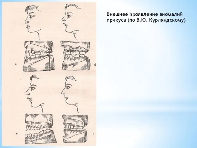 Внешнее проявление аномалий прикуса (по В.Ю. Курляндскому)