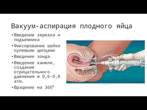 Вакуум-аспирация плодного яйца Введение зеркала и подъемника Фиксирование шейки пулевыми щипцами