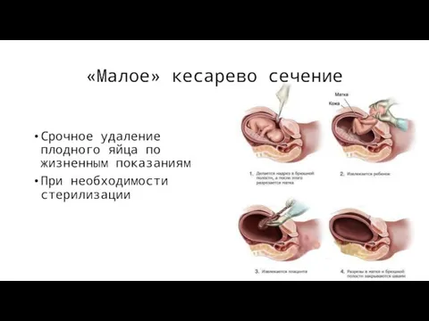 «Малое» кесарево сечение Срочное удаление плодного яйца по жизненным показаниям При необходимости стерилизации