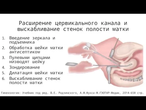 Расширение цервикального канала и выскабливание стенок полости матки Введение зеркала и