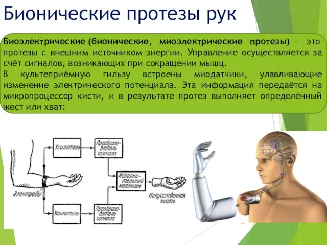 Бионические протезы рук Биоэлектрические (бионические, миоэлектрические протезы) — это протезы с