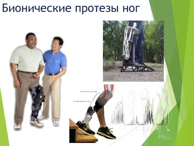 Бионические протезы ног