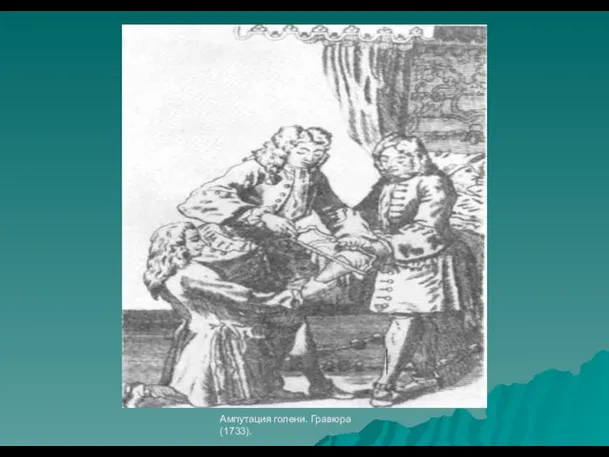 Ампутация голени. Гравюра (1733).