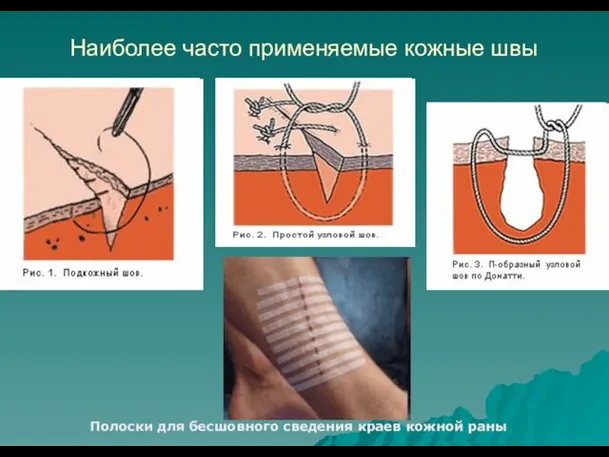 Наиболее часто применяемые кожные швы Полоски для бесшовного сведения краев кожной раны