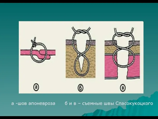 а -шов апоневроза б и в – съемные швы Спасокукоцкого