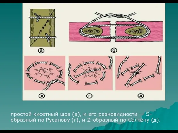 простой кисетный шов (в), и его разновидности — S-образный по Русанову
