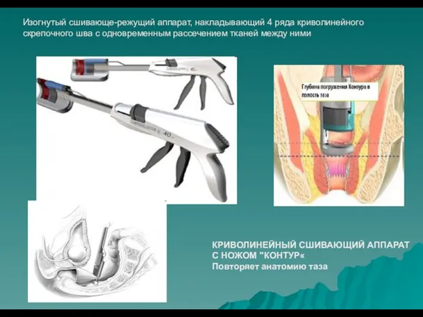 КРИВОЛИНЕЙНЫЙ СШИВАЮЩИЙ АППАРАТ С НОЖОМ "КОНТУР« Повторяет анатомию таза Изогнутый сшивающе-режущий