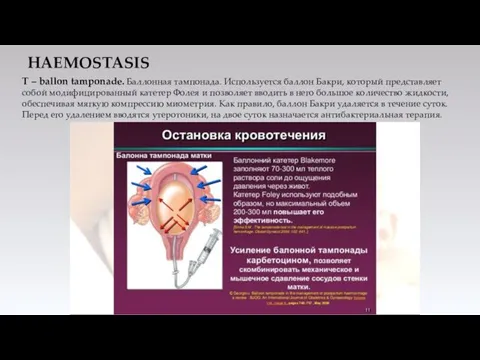 HAEMOSTASIS Т – ballon tamponade. Баллонная тампонада. Используется баллон Бакри, который