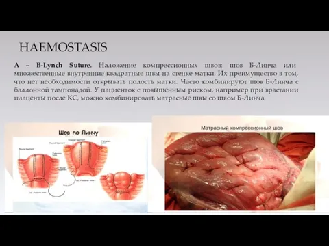 HAEMOSTASIS А – B-Lynch Suture. Наложение компрессионных швов: шов Б-Линча или