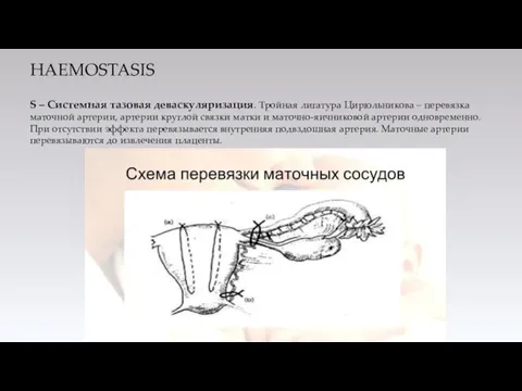 HAEMOSTASIS S – Системная тазовая деваскуляризация. Тройная лигатура Цирюльникова – перевязка