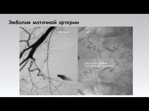 Эмболия маточной артерии