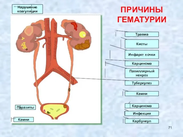 ПРИЧИНЫ ГЕМАТУРИИ Травма Инфаркт почки Кисты Карцинома Папиллярный некроз Карбункул Инфекция