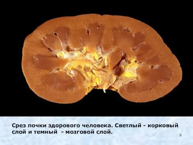 Срез почки здорового человека. Светлый - корковый слой и темный - мозговой слой.