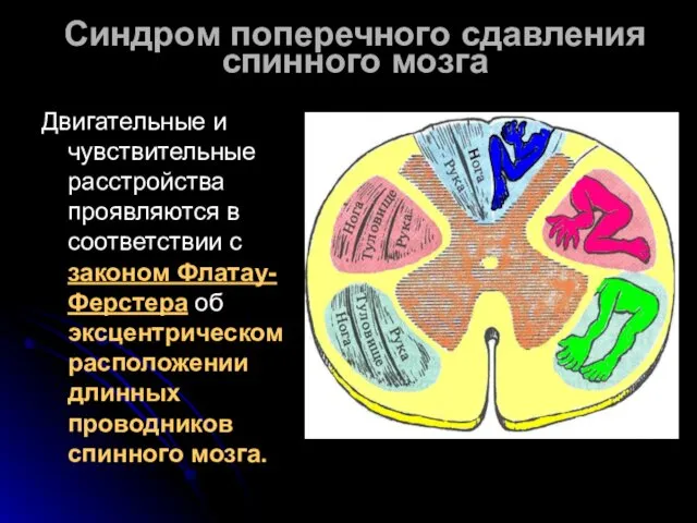 Синдром поперечного сдавления спинного мозга Двигательные и чувствительные расстройства проявляются в