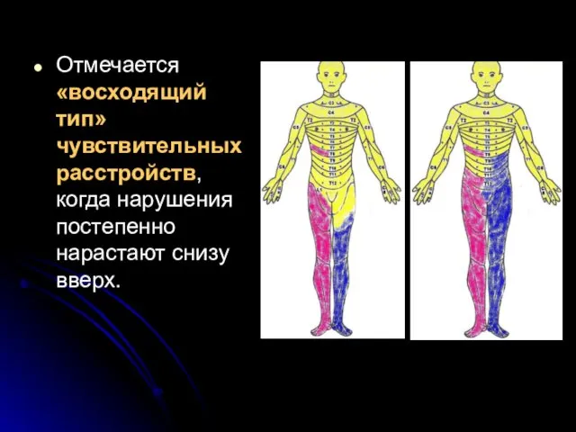 Отмечается «восходящий тип» чувствительных расстройств, когда нарушения постепенно нарастают снизу вверх.