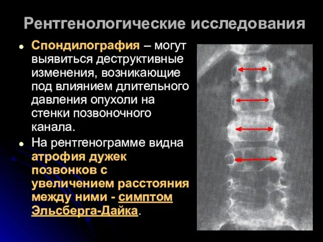 Рентгенологические исследования Спондилография – могут выявиться деструктивные изменения, возникающие под влиянием