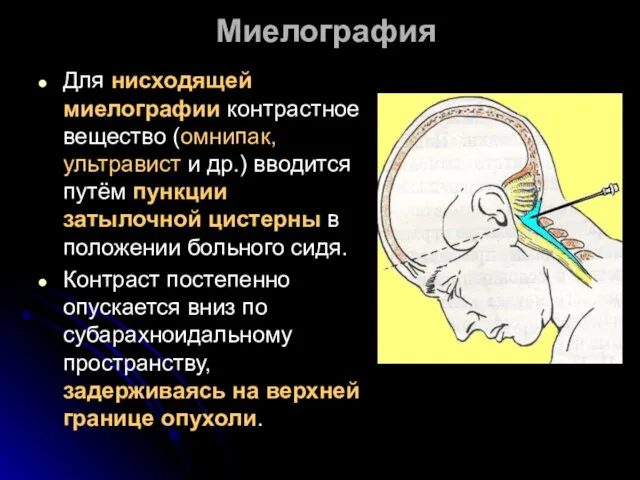 Миелография Для нисходящей миелографии контрастное вещество (омнипак, ультравист и др.) вводится