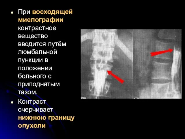 При восходящей миелографии контрастное вещество вводится путём люмбальной пункции в положении