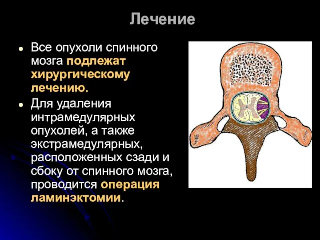 Лечение Все опухоли спинного мозга подлежат хирургическому лечению. Для удаления интрамедулярных