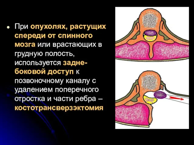 При опухолях, растущих спереди от спинного мозга или врастающих в грудную