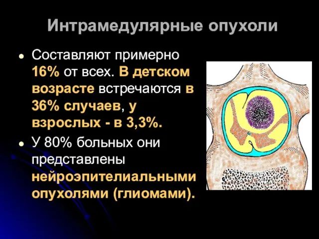 Интрамедулярные опухоли Составляют примерно 16% от всех. В детском возрасте встречаются