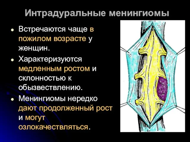 Интрадуральные менингиомы Встречаются чаще в пожилом возрасте у женщин. Характеризуются медленным