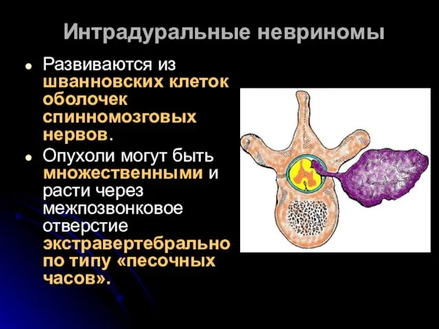 Интрадуральные невриномы Развиваются из шванновских клеток оболочек спинномозговых нервов. Опухоли могут