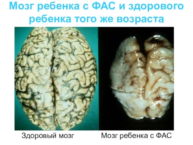 Мозг ребенка с ФАС и здорового ребенка того же возраста Здоровый мозг Мозг ребенка с ФАС