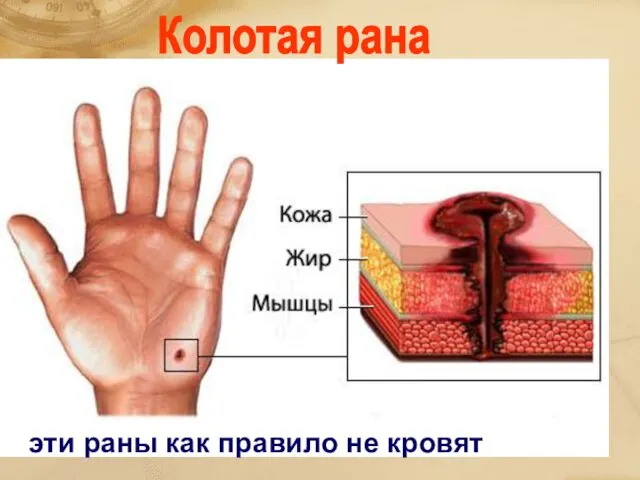 Колотая рана эти раны как правило не кровят