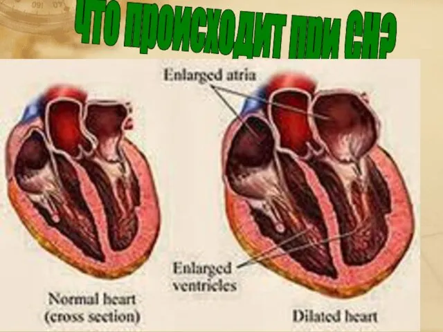 что происходит при СН?