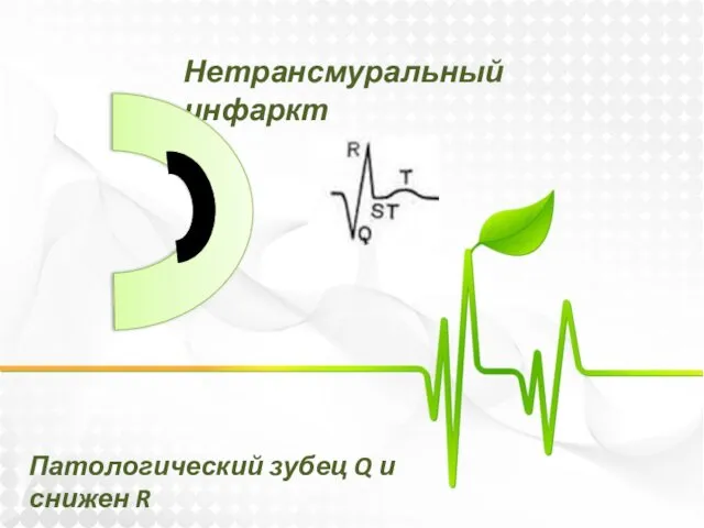 Нетрансмуральный инфаркт Патологический зубец Q и снижен R