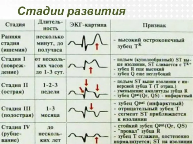 Стадии развития инфаркта